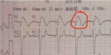 昏迷患者血钾升至 10.22mmol/L，原来早有征兆!