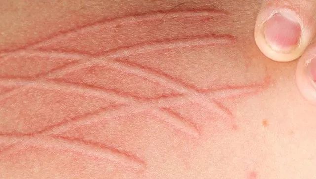 5 类常见儿童荨麻疹,你是否都已掌握?
