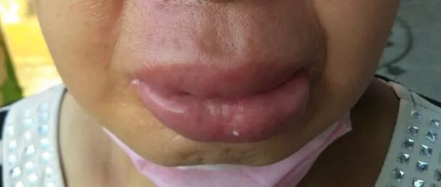 丁香病例 |  传说中的「香肠嘴」？难道因为嘴馋一时爽？