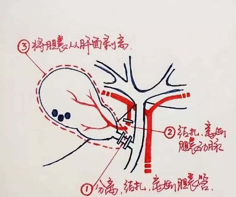 还在死磕胆结石手术操作？手绘图教你一秒看明白