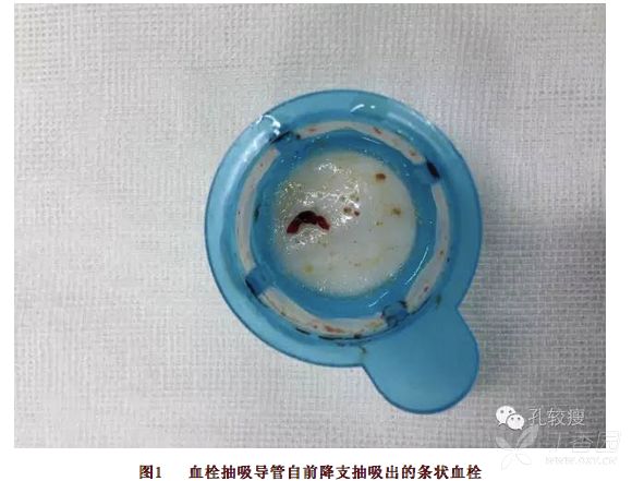 丁香病例 |  反复心梗、反复脑梗、反复消化道出血，这是啥情况？