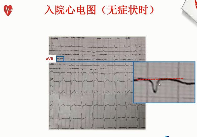 【含病例】告别死记硬背，心电图这样学习不会都难