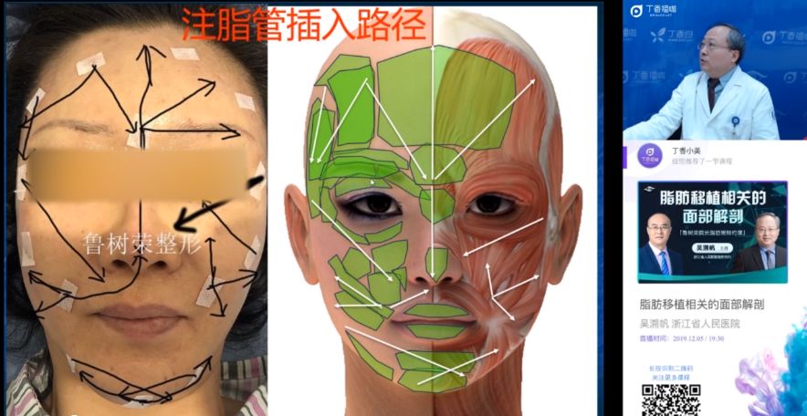 整形大咖开讲 |吴溯帆教授《脂肪移植相关的面部解剖》