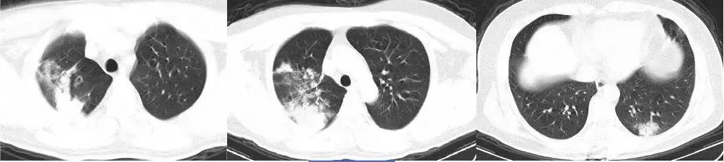 4 次核酸阴性后 CT 确诊，新冠肺炎 CT 表现 5 个特点请牢记