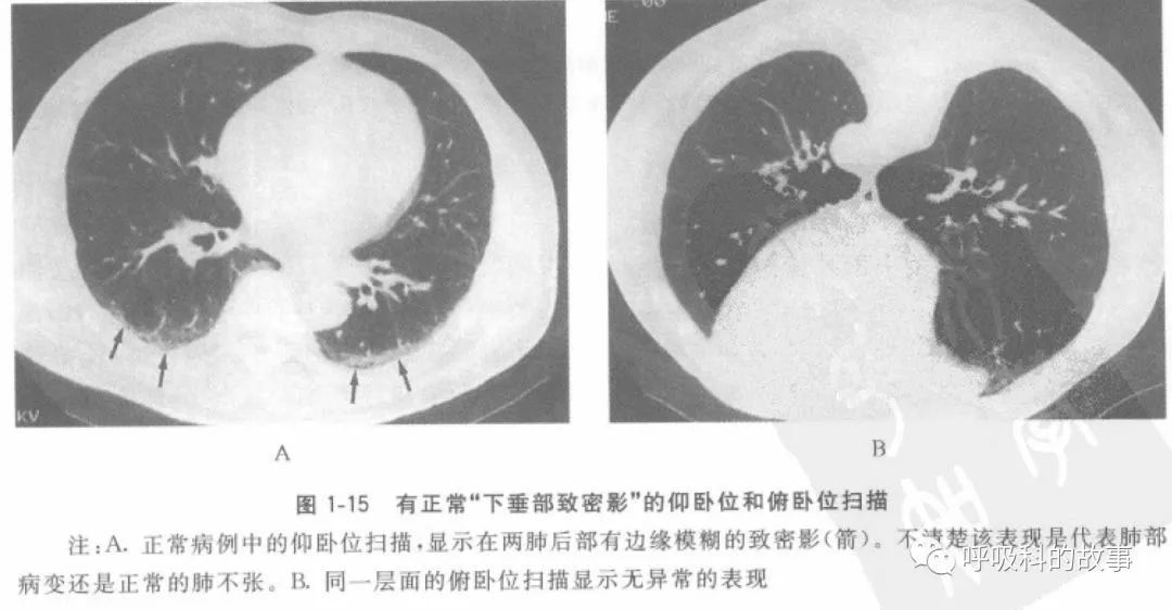 新冠鉴别：双肺疑似毛玻璃影，改变体位结果大不同