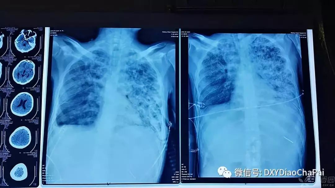 患者入院五天后死亡，仅从胸片你能做出诊断吗？