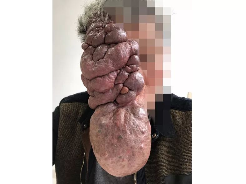 切除巨大瘤体的 9h「换脸」手术,和背后优秀的整形外科医生 切除巨大瘤体的 9h「换脸」手术,和背后优秀的整形外科医生