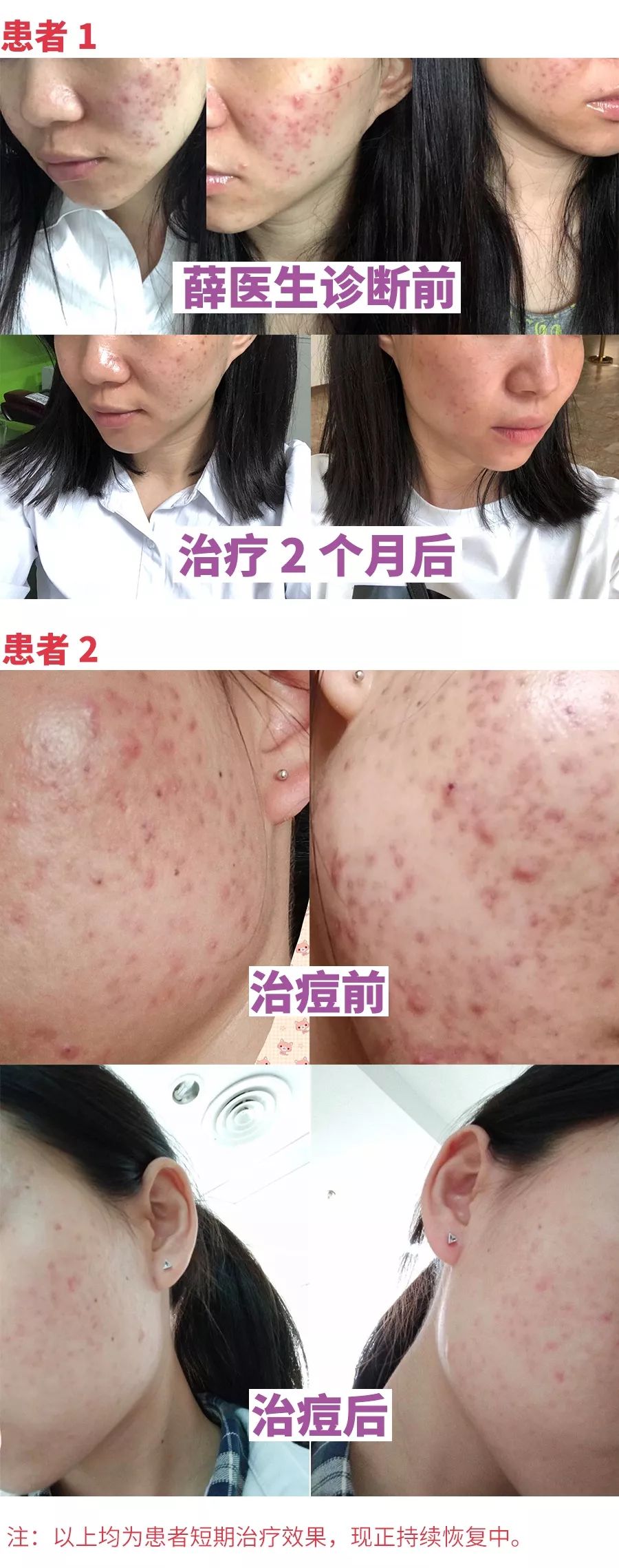 反复长痘怎么治？做对这件事很关键