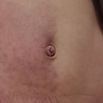 丁香病例 | 罕见！八岁男孩身体两侧皮肤不同色，怎么回事？