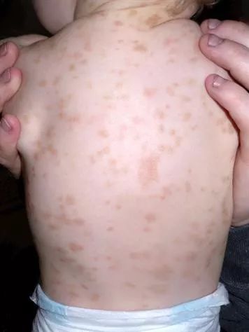 5 类常见儿童荨麻疹，你是否都已掌握？