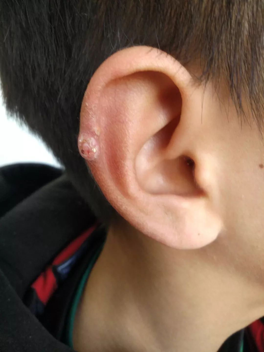28 岁女子足底红斑久治不愈，追问病史，原因竟然是......