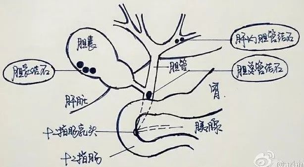 还在死磕胆结石手术操作？手绘图教你一秒看明白