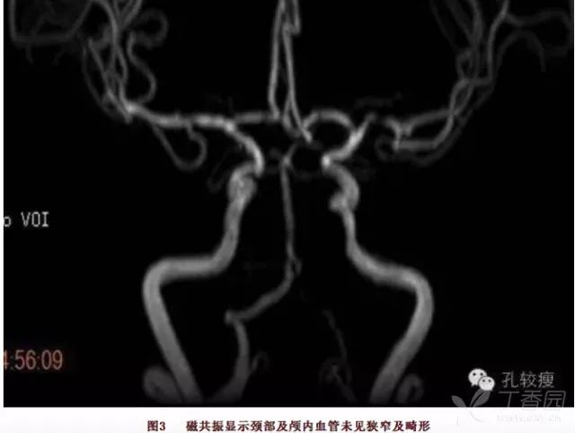 丁香病例 |  反复心梗、反复脑梗、反复消化道出血，这是啥情况？