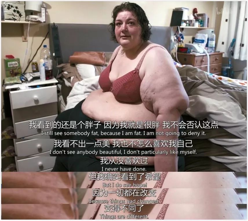 为了减肥，她勇敢切掉了 3/4 的胃和 1/3 的小肠
