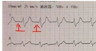 昏迷患者血钾升至 10.22mmol/L，原来早有征兆!