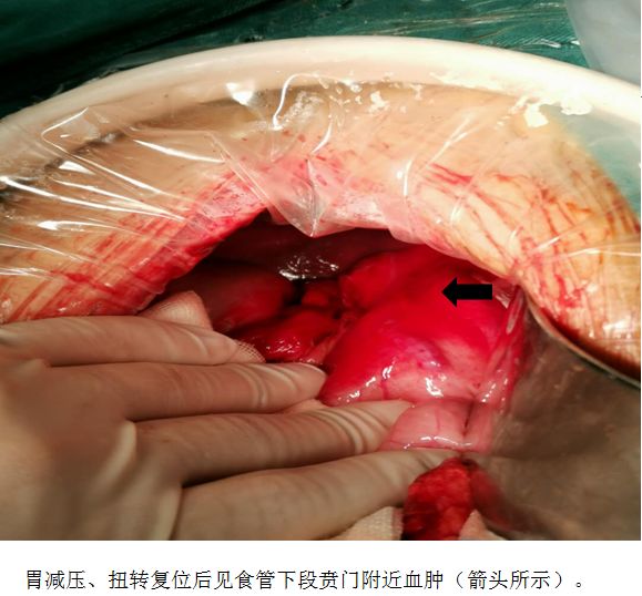 从膈下到盆腔，你见过这么严重的胃扩张吗？