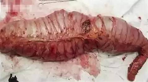 我们发现一个「真 · 巨结肠」的罕见病例