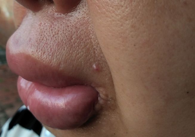 丁香病例 |  传说中的「香肠嘴」？难道因为嘴馋一时爽？