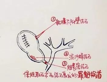 还在死磕胆结石手术操作？手绘图教你一秒看明白