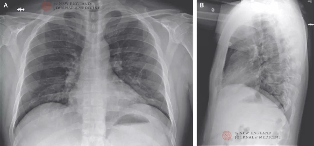 重磅！美国首例新冠病毒肺炎治疗康复全过程 | NEJM 官方翻译
