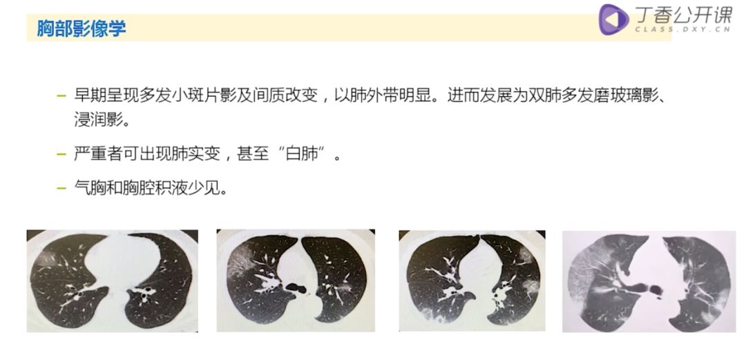 4 次核酸阴性后 CT 确诊,新冠肺炎 CT 表现 5 个特点请牢记 4 次核酸阴性后 CT 确诊,新冠肺炎 CT 表现 5 个特点请牢记