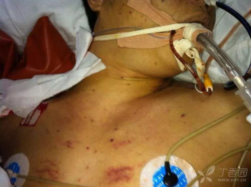 发病到死亡仅 3 天，腹痛，水痘、肝衰竭？原因究竟是什么？