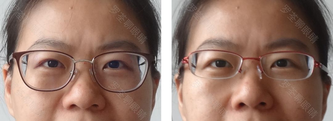 戴近视眼镜后，真的会「变丑」？眼科医生坐不住了