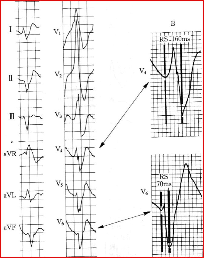 4 步法则鉴别宽 QRS 波心动过速：「室速」or「室上速」