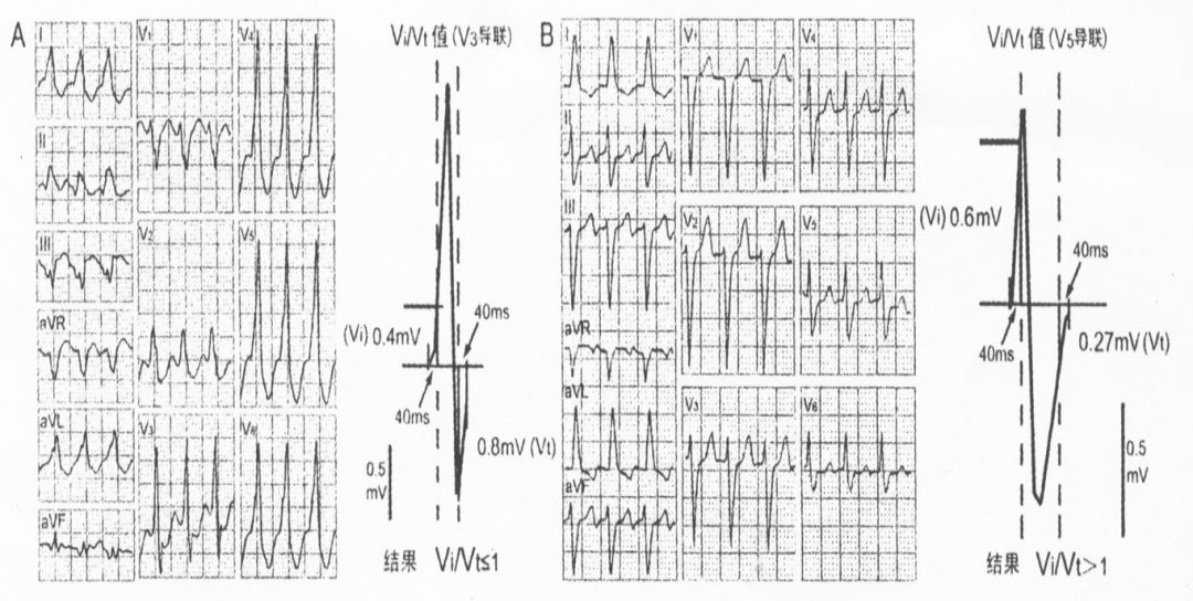 4 步法则鉴别宽 QRS 波心动过速：「室速」or「室上速」