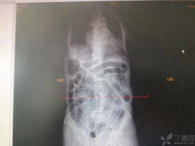剧烈腹痛，入院 12 小时死亡 | 丁香病例