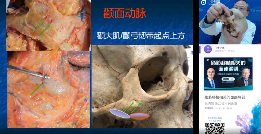 整形大咖开讲 |吴溯帆教授《脂肪移植相关的面部解剖》