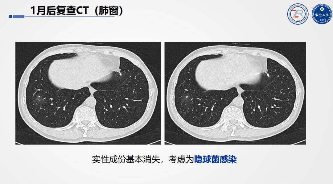 准确判读「肺部结节」，这个要点你一定要掌握