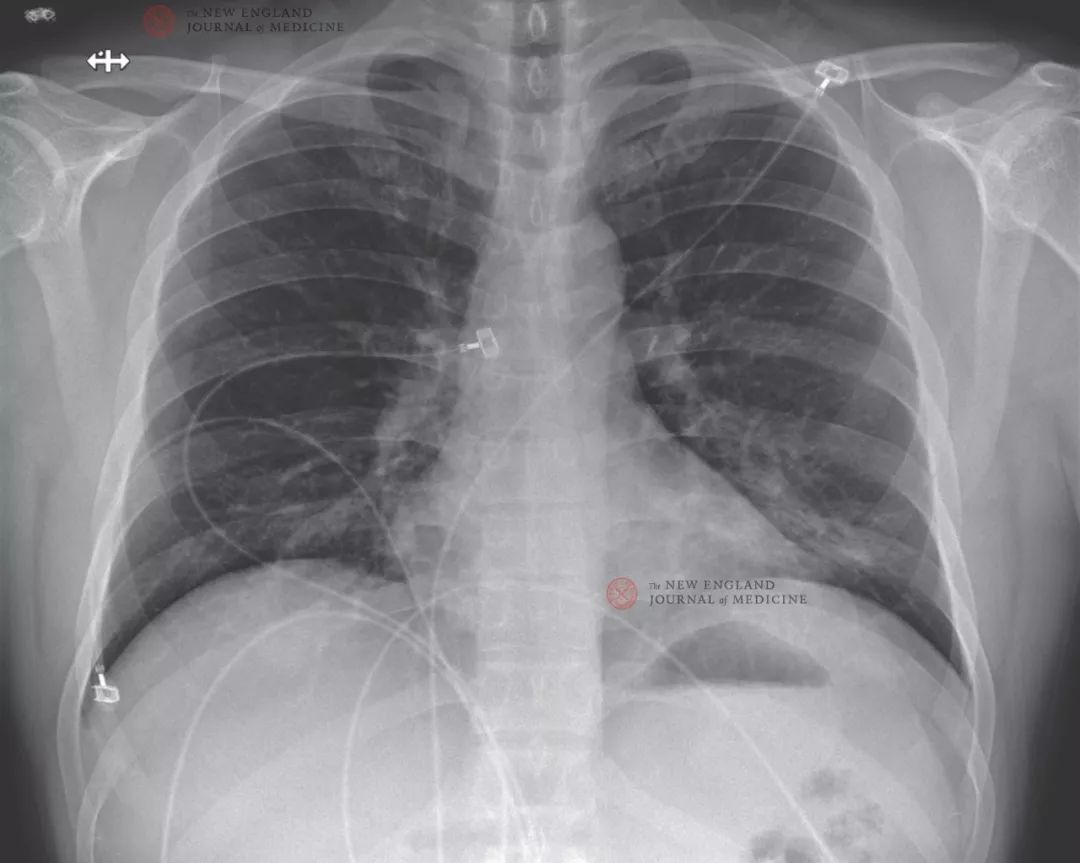 重磅！美国首例新冠病毒肺炎治疗康复全过程 | NEJM 官方翻译