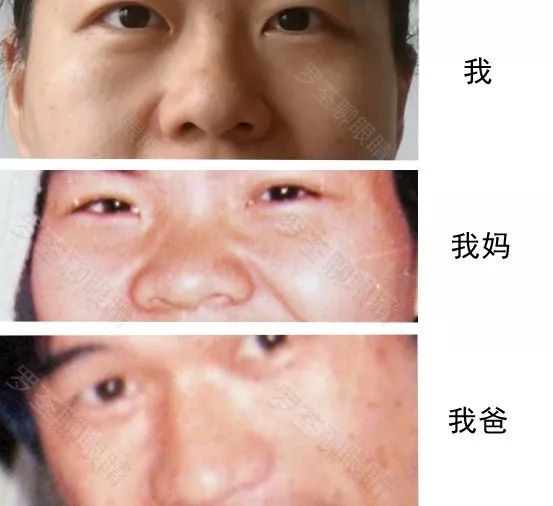 戴近视眼镜后，真的会「变丑」？眼科医生坐不住了