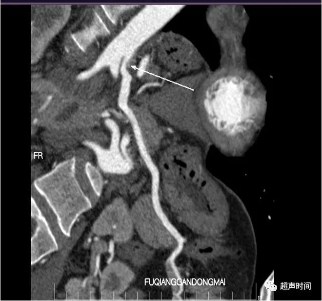 患者腹痛 3 年，发现病因竟是一根血管