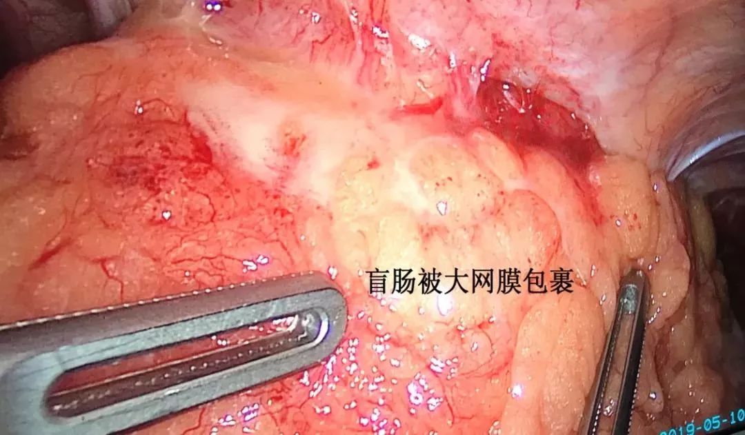 这种病几乎 100% 误诊为阑尾炎，你能否准确识别？