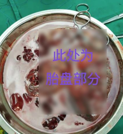 丁香病例 | 剖宫产的产妇取下胎盘，血为什么是白色的？