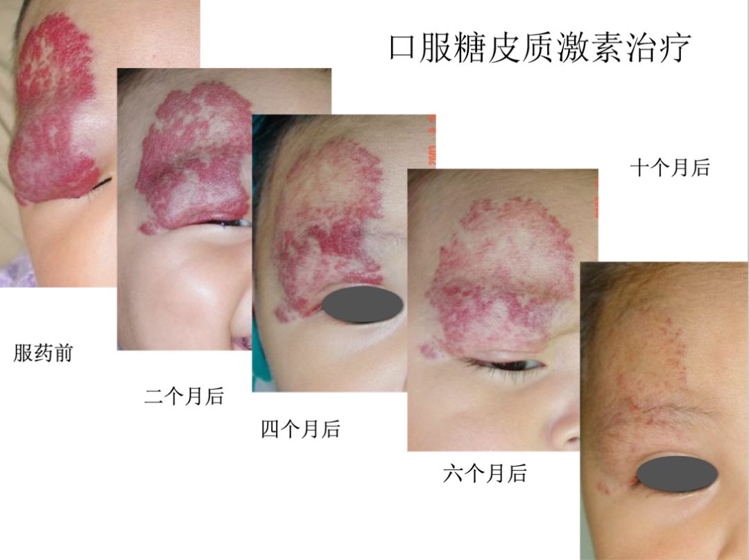血管瘤：听说最近流行分享病例？这里管够
