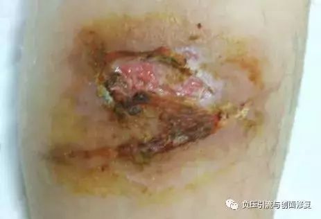 碘伏消毒 20 天后，慢性创面却肿痛加重