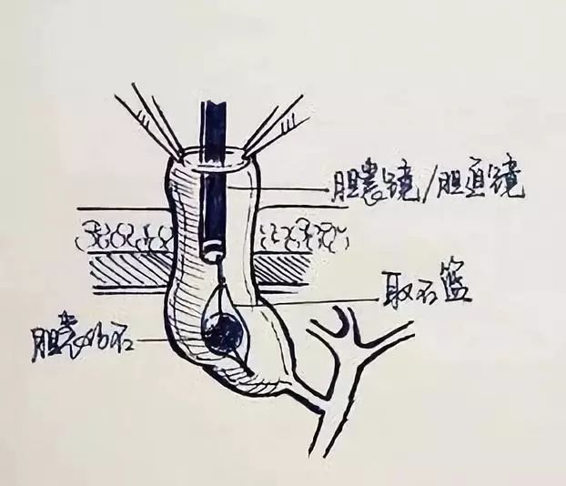 还在死磕胆结石手术操作？手绘图教你一秒看明白