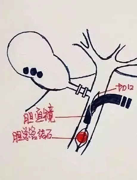 还在死磕胆结石手术操作？手绘图教你一秒看明白