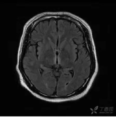 丁香病例 |  吐着吐着就「疯了」？这个孕妇怎么了？
