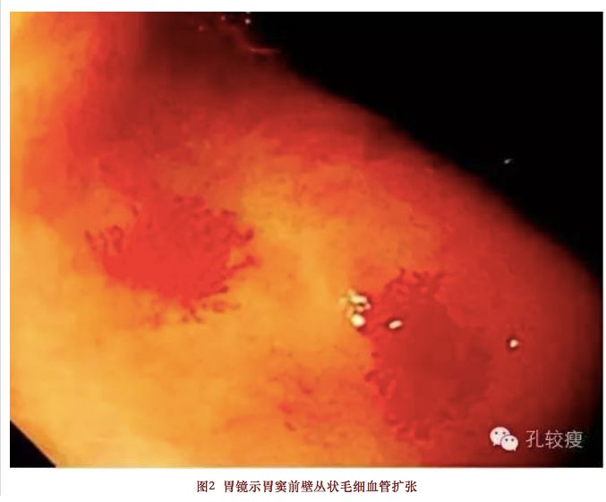 丁香病例 |  反复心梗、反复脑梗、反复消化道出血，这是啥情况？