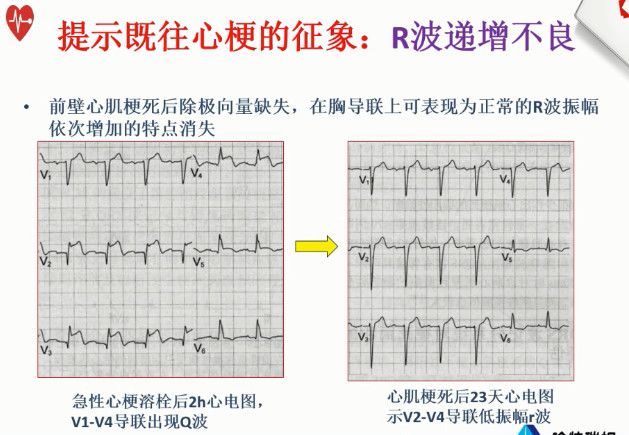 【含病例】告别死记硬背，心电图这样学习不会都难
