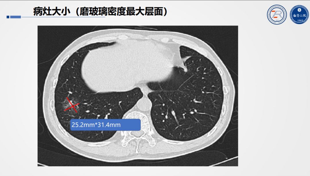 准确判读「肺部结节」，这个要点你一定要掌握