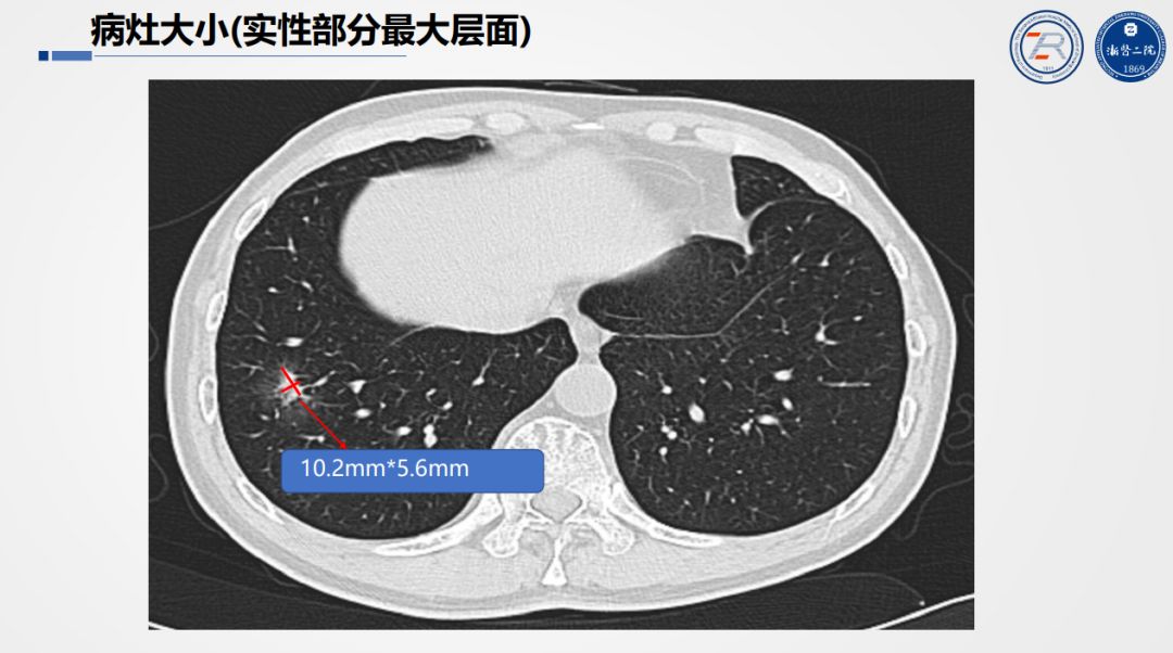 准确判读「肺部结节」，这个要点你一定要掌握