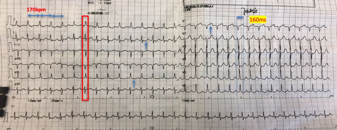 不靠死记硬背？心电图到底应该怎么学