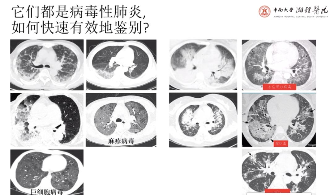 4 次核酸阴性后 CT 确诊，新冠肺炎 CT 表现 5 个特点请牢记