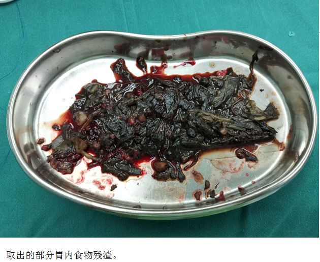 从膈下到盆腔，你见过这么严重的胃扩张吗？