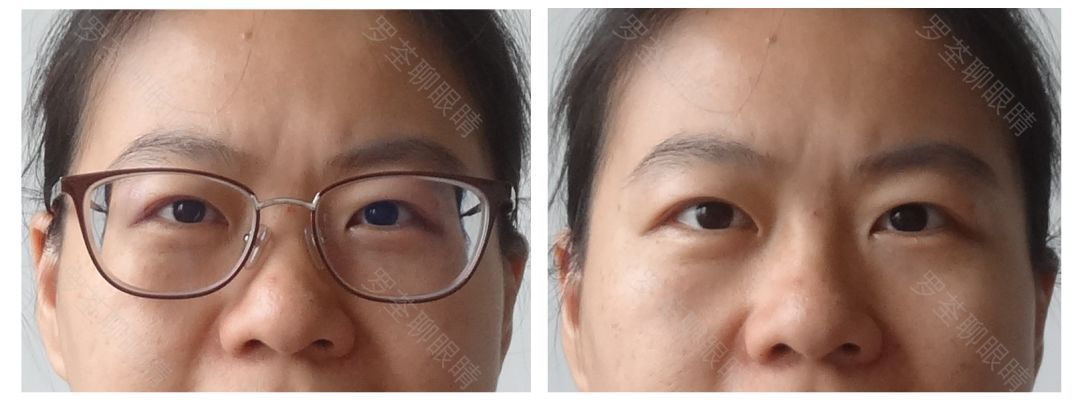 戴近视眼镜后，真的会「变丑」？眼科医生坐不住了
